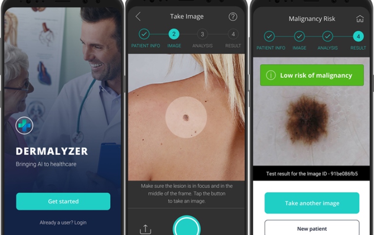 Dermalyzer, ett AI-stöd som hjälper läkare att diagnostisera hudcancer