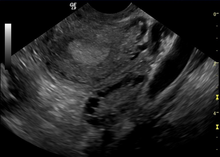 Ultrasound examination of polycystic ovary.