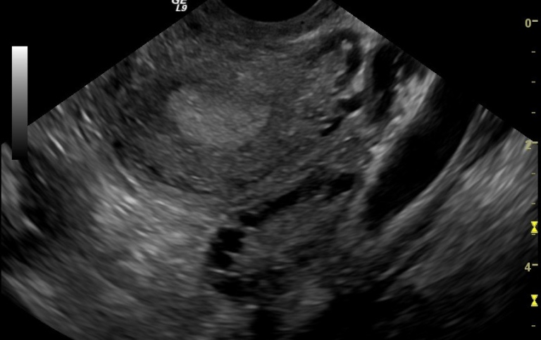 Ultrasound examination of polycystic ovary. 